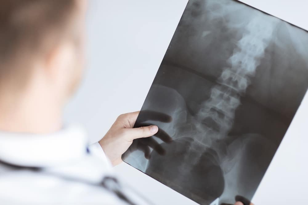 doctor holding x-ray of spine